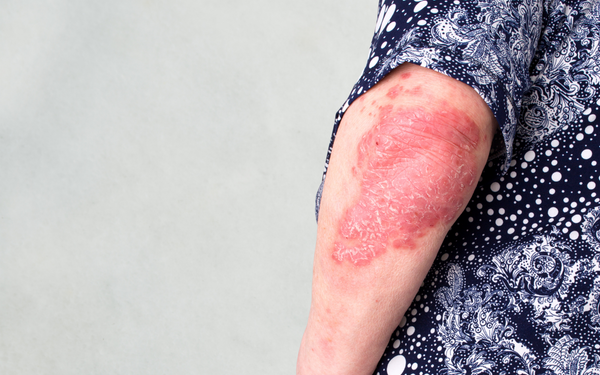 Psoriasis Top Tips To Prevent Flare-Ups