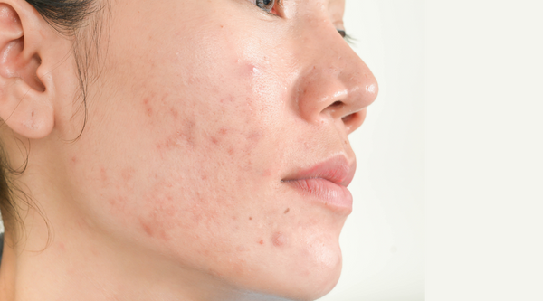 Summer Skincare Tips for Acne-Prone Skin